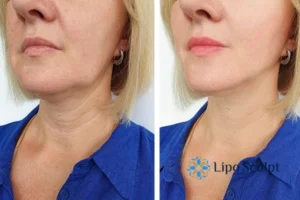 Double chin before and after Hi-Fu treatment 4 Book your double chin treatment Buckingham today! We are here to help!
