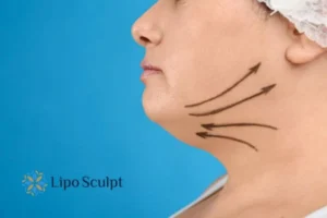 Double chin before and after Hi-Fu treatment 3 Boost your confidence with a Double chin treatment Buckingham