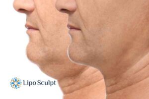 Double chin before and after Hi-Fu treatment 2 Double chin treatment Buckingham from Lipo Sculpt - feel more confident today!