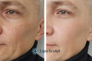 How to Fight Aging Symptoms 3 Fight Aging Symptoms Buckingham With HIFU and Morpheus8 Today!