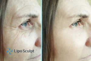 How to Fight Aging Symptoms 2 Do you want to Fight Aging Symptoms Buckingham? Contact Lipo Sculpt today!
