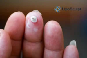 Cryopen Top 5 Treatable Conditions 4 Do you have a persistent wart of verruca that you cannot shit? Cryopen Buckingham treatment will work call us NOW!
