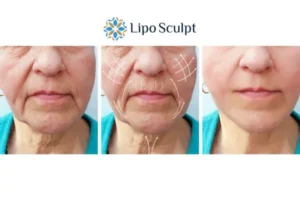 Explaining Morpheus8 And What It Can Do For You 3 Boost your confidence with Morpheus8 Buckingham call our team today!