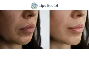 Explaining Morpheus8 And What It Can Do For You 4 Morpheus8 Buckingham the best results - call our team today!