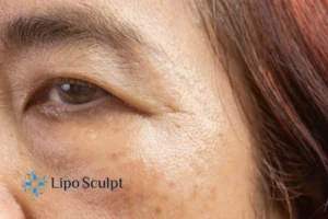 Cryopen: The Revolutionary Treatment for Age Spots Unveiled 2 Are age spots Buckingham giving you low self esteem? Contact us today!