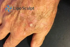 Best Actinic Keratoses Removal 2 Improve your wellbeing and health with Actinic Keratoses Buckingham removal.treatment