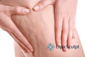 CoolSculpting for Legs: The Innovative Approach to Redefining Your Legs 5 Start your journey today book your coolsculpting treatment Buckingham online today!