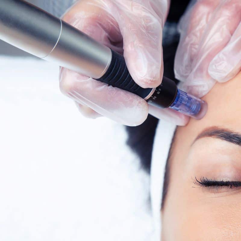 Morpheus8 treatment Buckingham from Lipo Sculpt - Book in today!