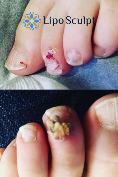 Wart removal customer results from Lipo Sculpt Buckingham