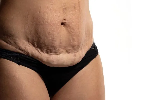 Lost the Weight but Not the Loose Skin? 1 image of womans stomach after weight loss showing loose skin Buckingham